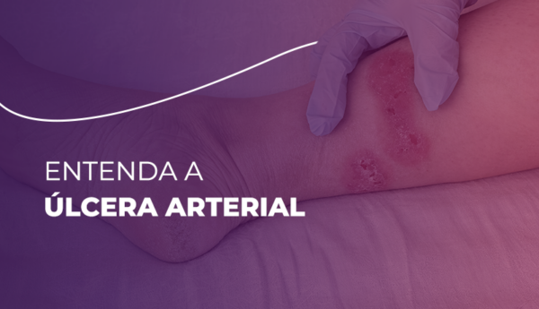 Entenda a Úlcera Arterial Blog Júpiter