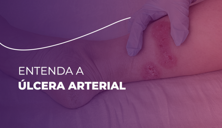 Úlcera Arterial